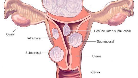 a photo of uterine fibroids that may require surgery options such as myomectomy or hysterectomy