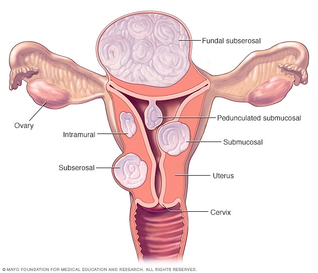 Uterine Fibroids Surgery How To Choose Between A Hysterectomy And A Myomectomy